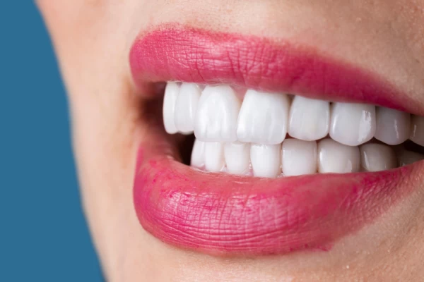 dental veneers