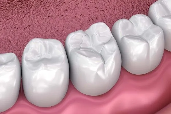 Ceramic Fillings