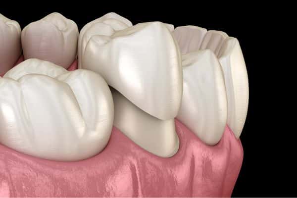 Dental Crowns