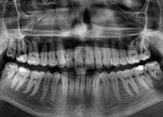 Dental X Rays