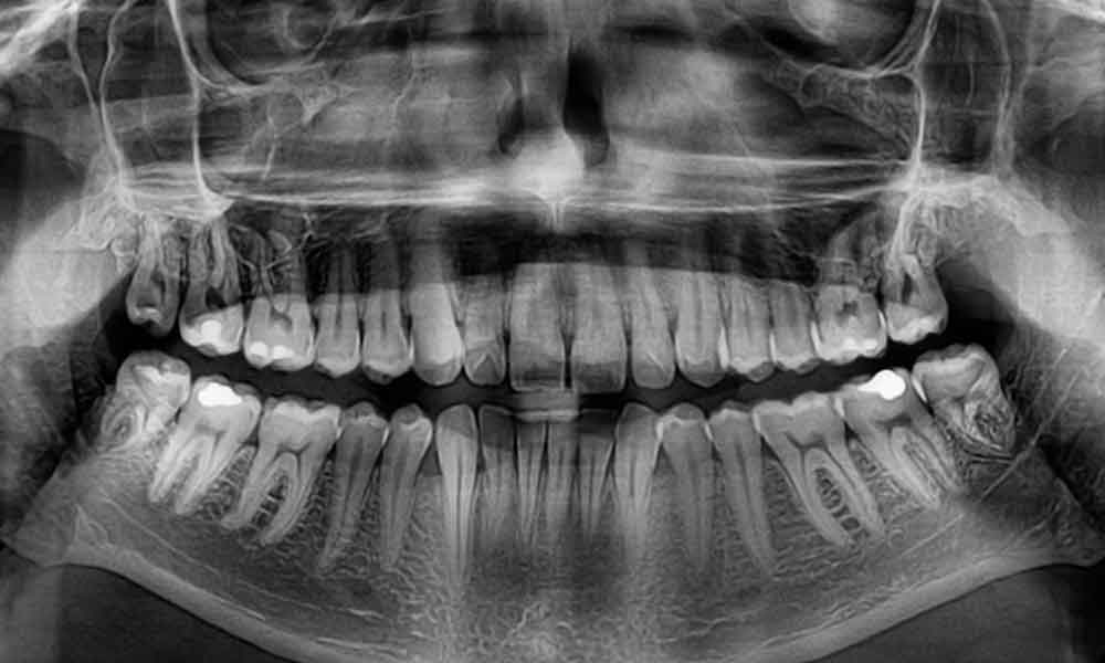 Dental X Rays